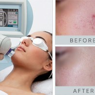 Laser Treatments